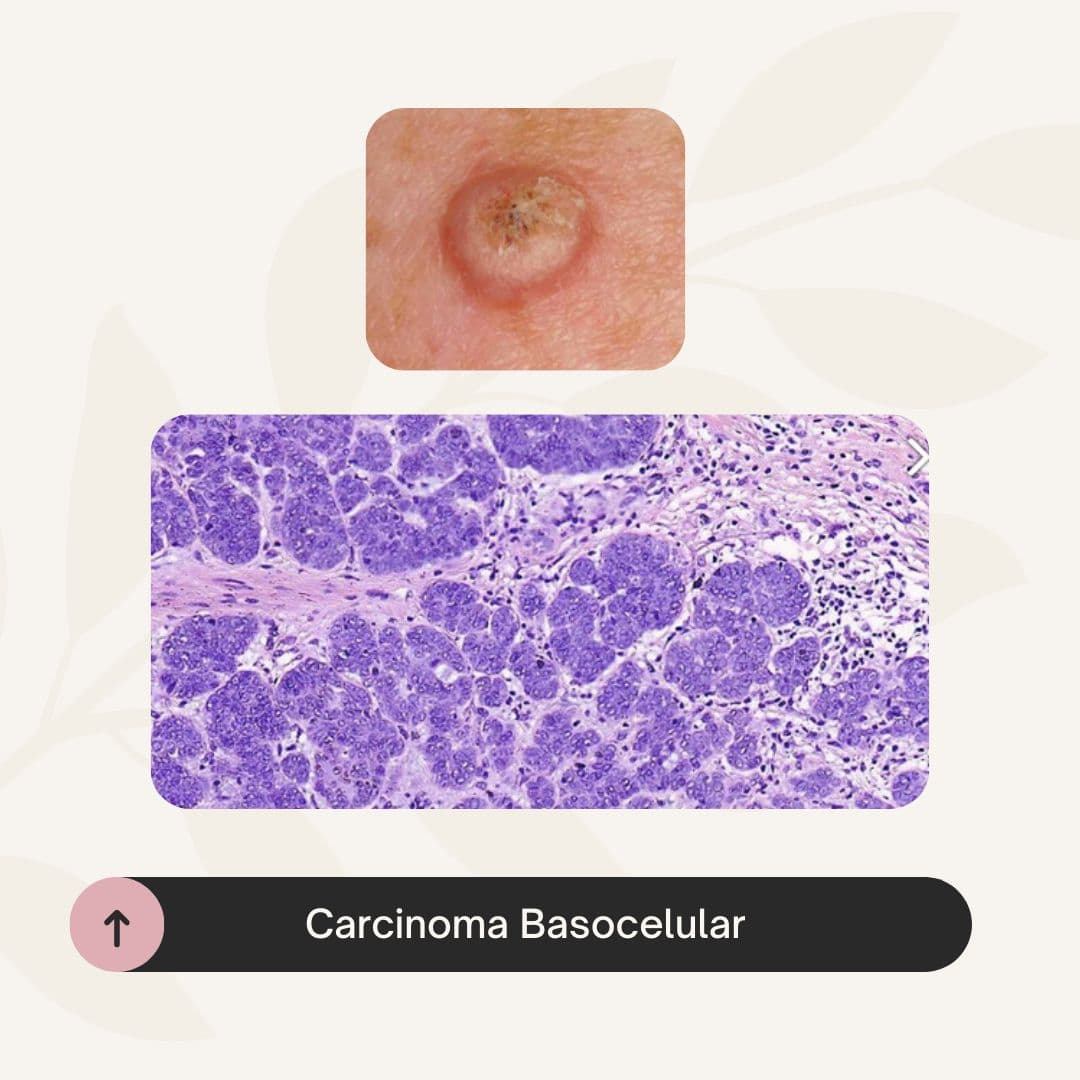 Carcinoma basocelular