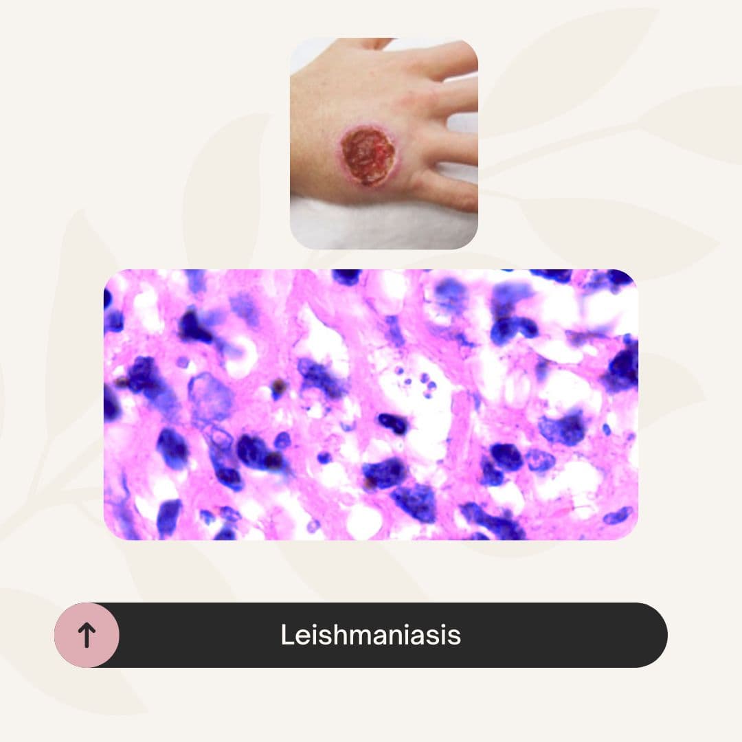 Leishmaniasis