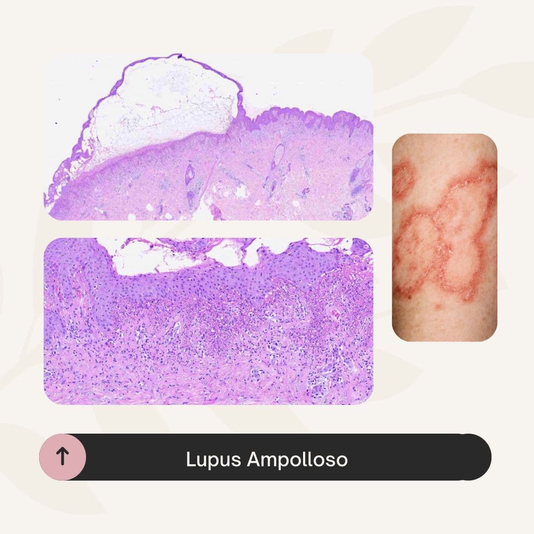Lupus Ampolloso