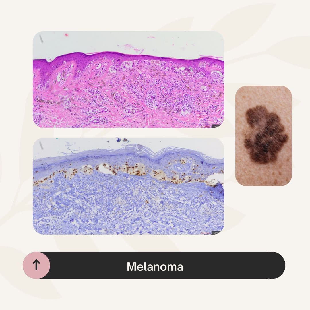 Melanoma en la unión dermoepidérmica