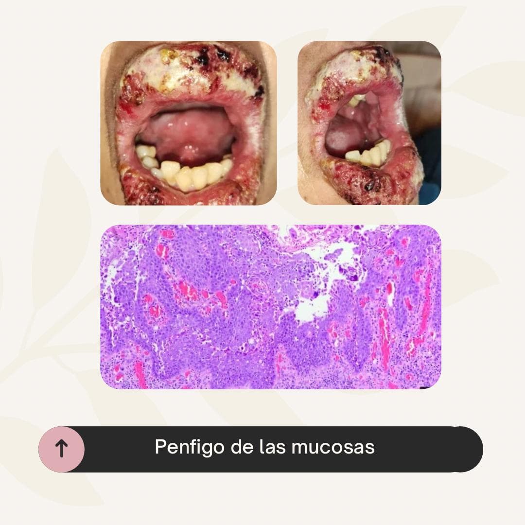 Pénfigo de mucosas