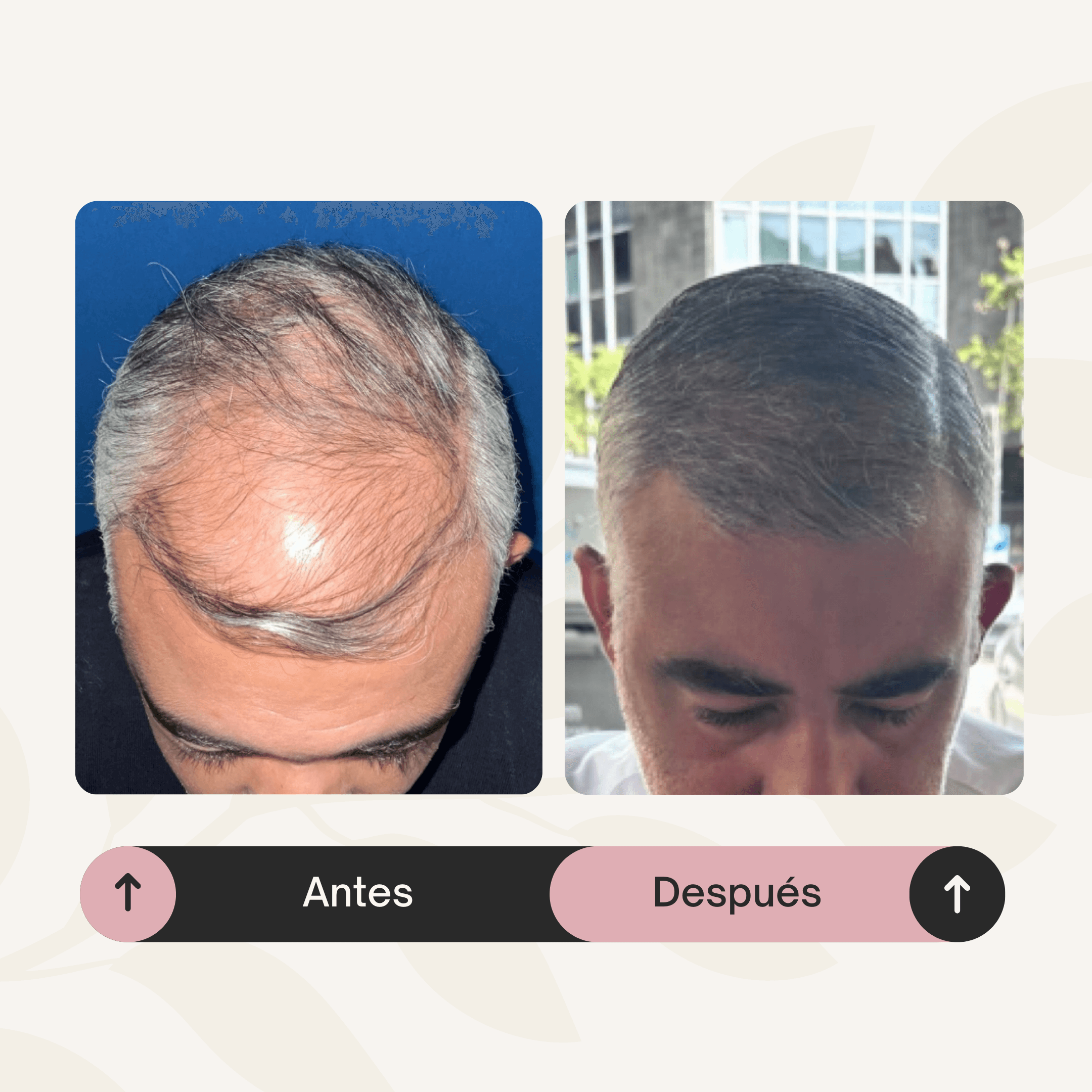 Implante capilar frontal y zona media