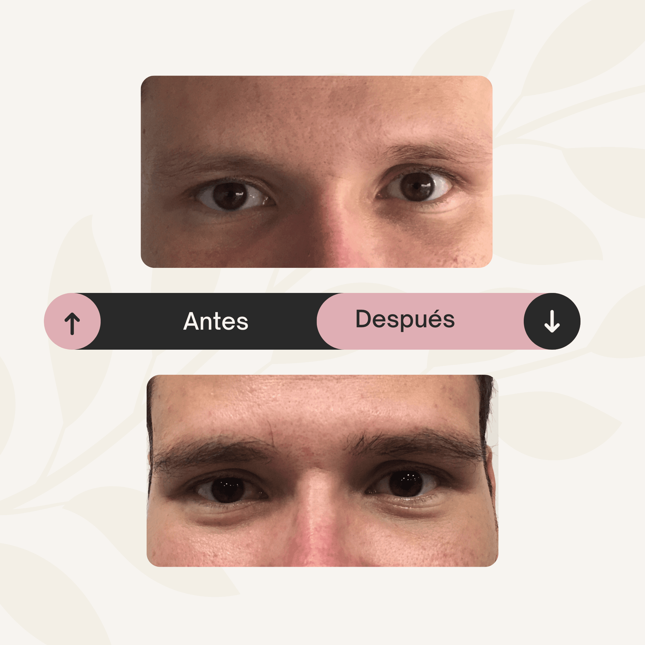 Implante capilar en cejas