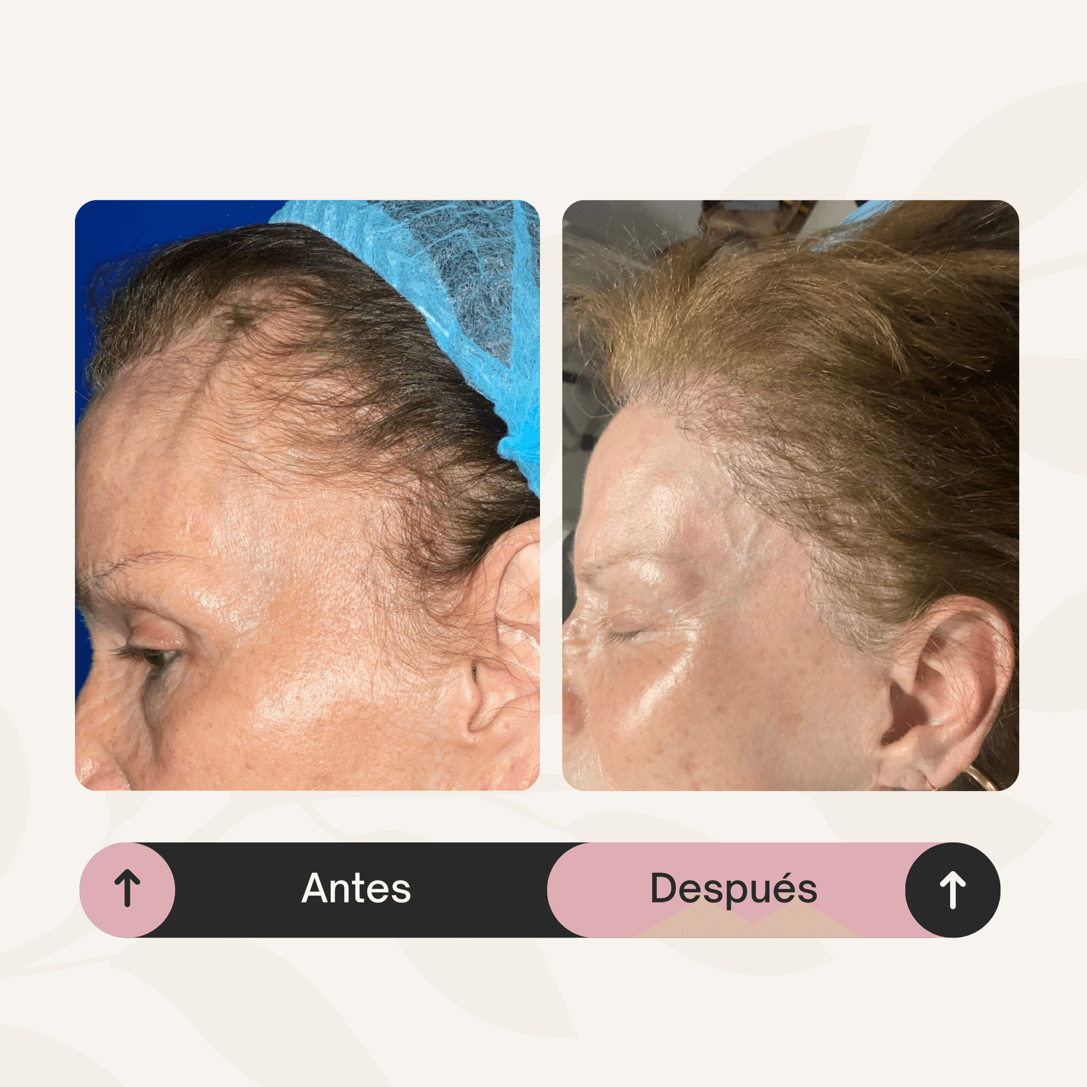 Implante capilar para cicatrices