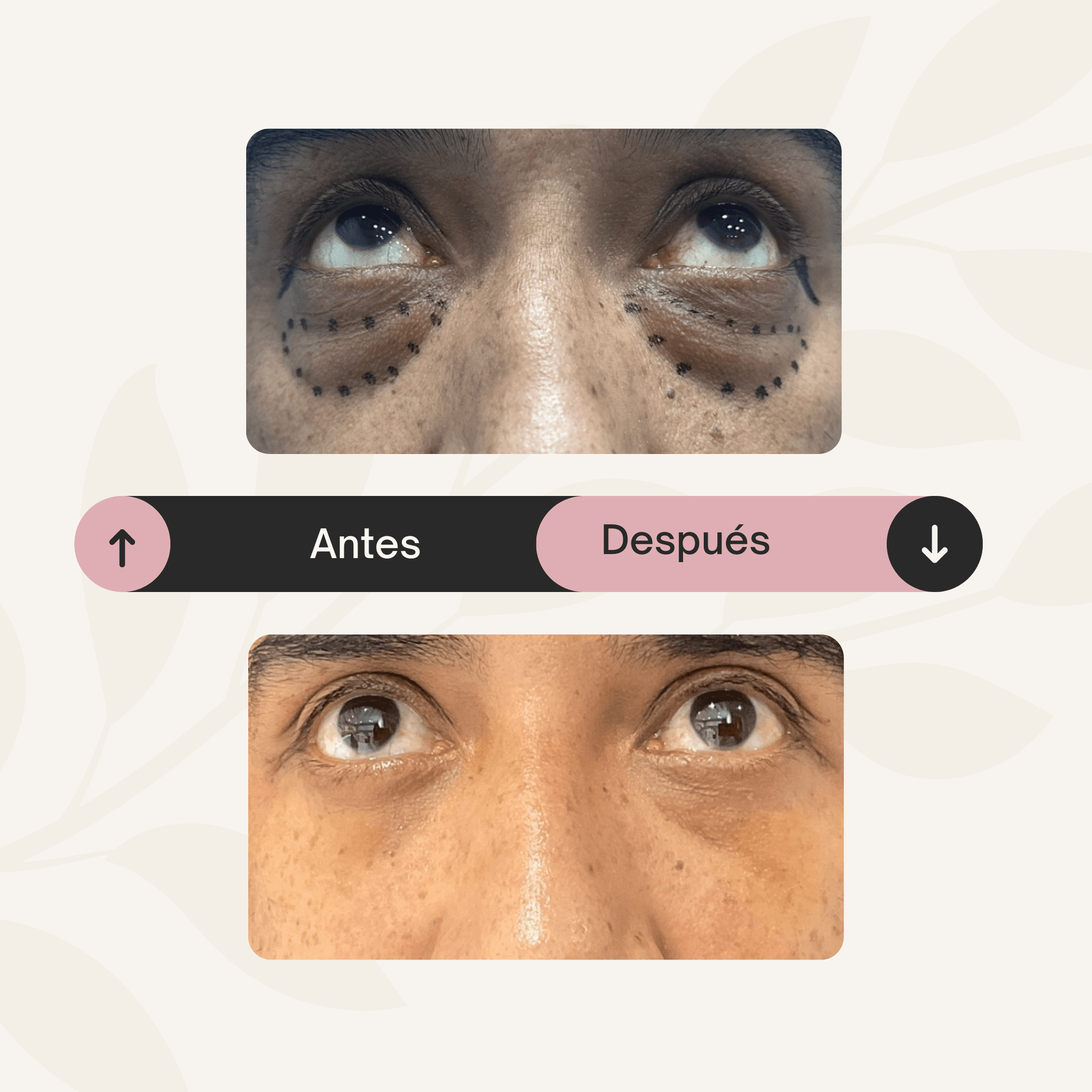 Rejuvenecimiento de la mirada con blefaroplastia inferior