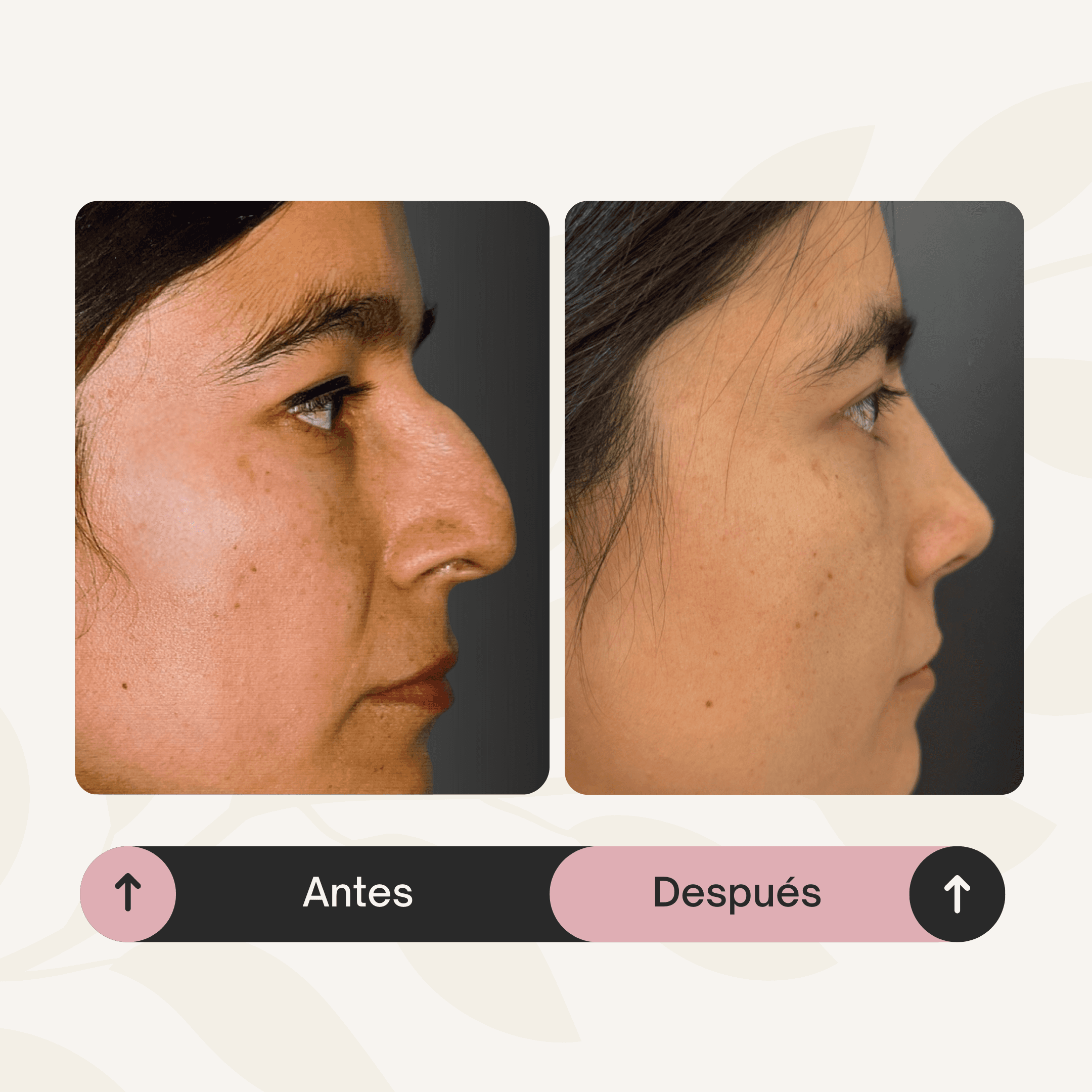 Rinoseptoplastia con reducción de giba y definición nasal