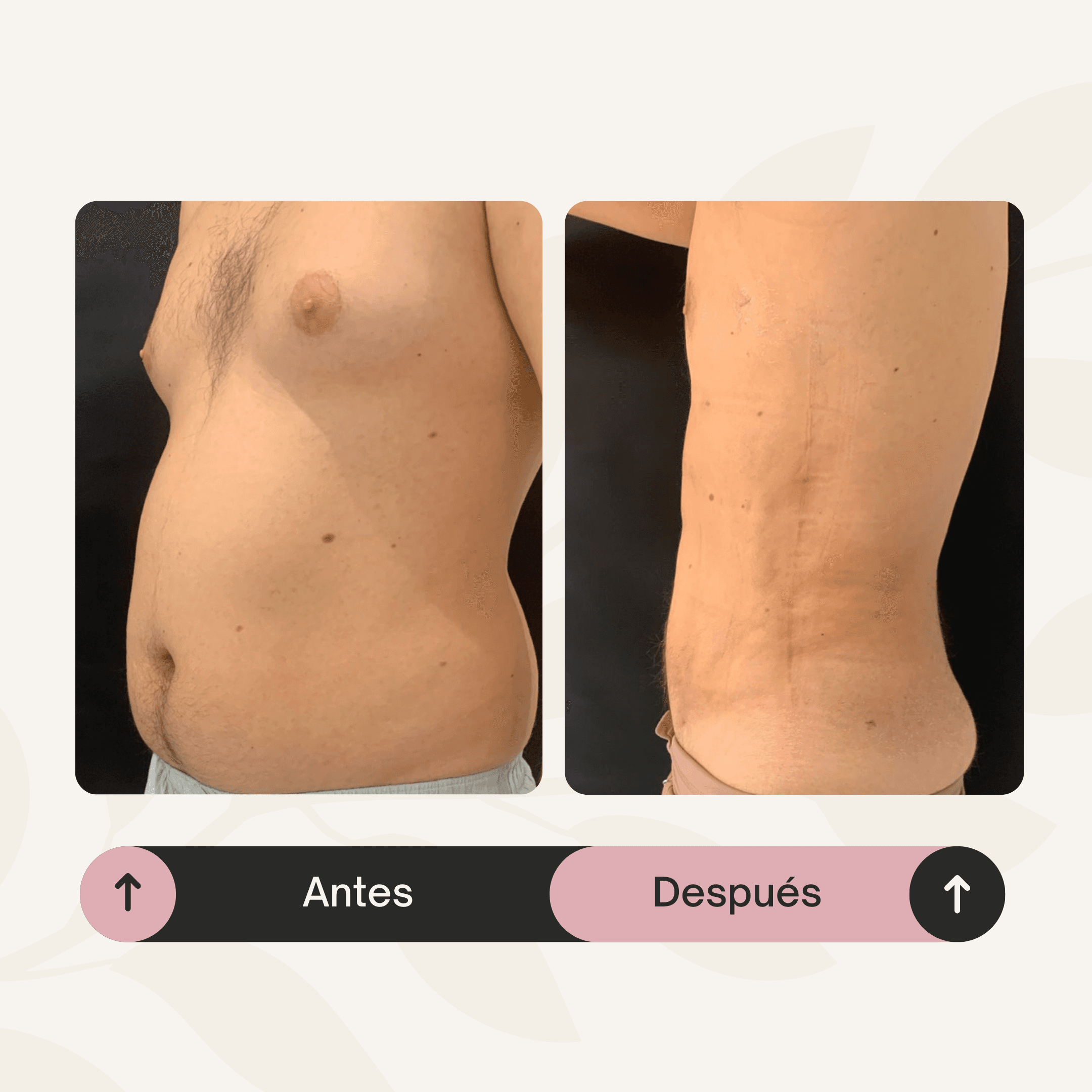 Liposucción de abdomen y flancos con corrección de ginecomastia.